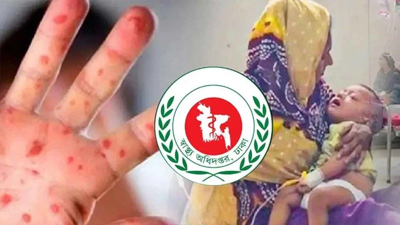 হাম উপসর্গে আরও ৪ শিশুর মৃত্যু