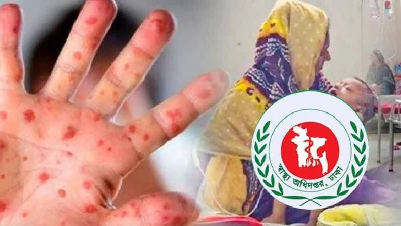 হামের উপসর্গ নিয়ে আরও ৩ মৃত্যু, আক্রান্ত ১২৫৯
